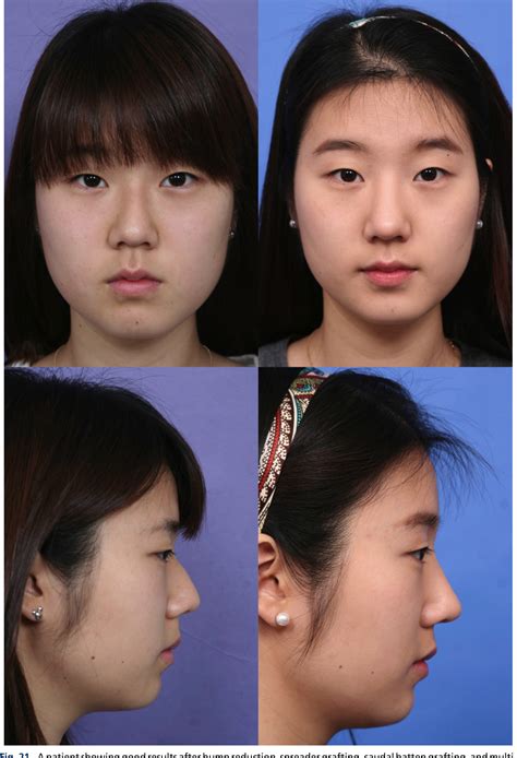 Figure 4 from Rhinoplasty in the Asian nose. | Semantic Scholar