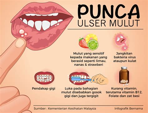 Punca Ulser Mulut Bayi - Punca Puncak