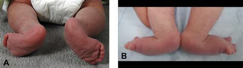 Congenital vertical talus causes, symptoms, diagnosis, treatment & prognosis