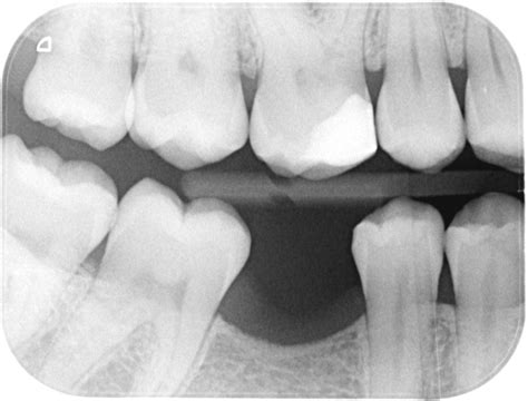 Why your Dentist takes X-rays... - Brucegate Dental Practice