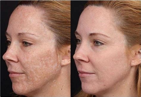 PRX T33 Medical Grade Chemical Peel - Sean Holt Clinic Botox Norwich