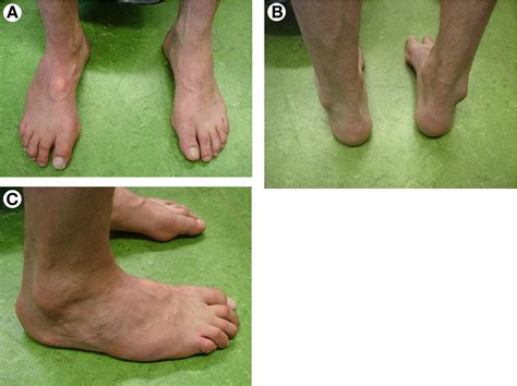 Significant Forefoot Varus Deformity Resulting in Progressive Stress Fractures of All Lesser ...