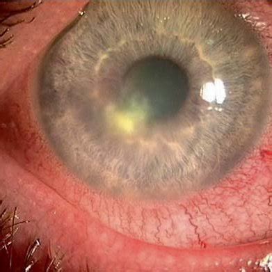 Patient 2: landscaped corneal infiltrate with intact epithelium and ...