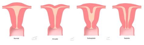 MYTH: You can’t carry to term with an arcuate uterus | National ...