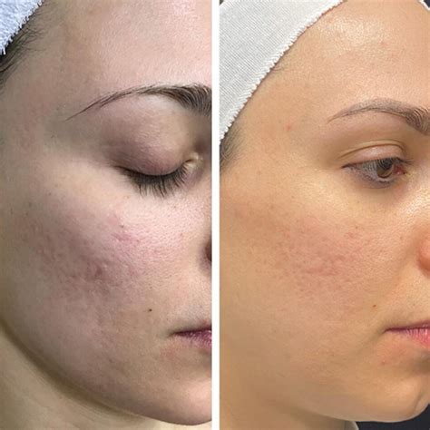 Before & After Microlaser Peel Procedures in Annapolis | Dr. O'Donnell