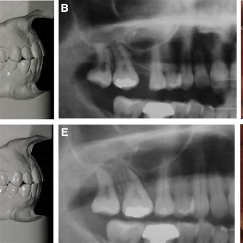 (PDF) Multidisciplinary management of permanent first molar extractions