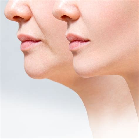 Double Chin Liposuction Turkey | Neck Lipo