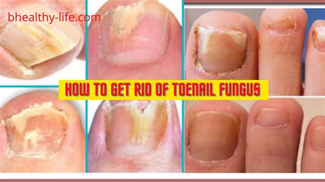 How to get rid of toenail fungus | Toenail Fungus Causes and Treatment - Bhealthy Life