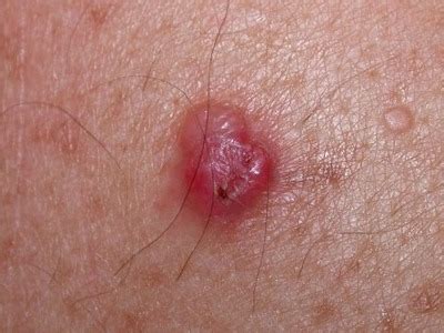 Melanoma Nodular: lo que necesita saber | Lima