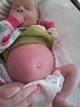 bloated belly *pic* | BabyCenter