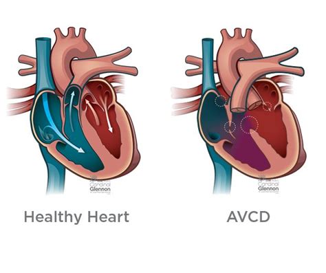 Atrioventricular canal defect (AVCD), also known as atrioventricular septal defect (AVSD) or ...
