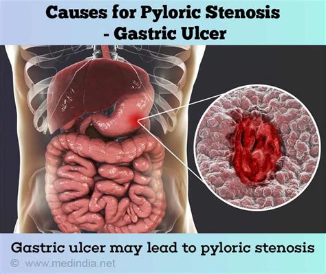 Causes of Pyloric Stenosis in Adults