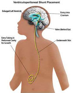 Ventriculoperitoneal Shunt Complications