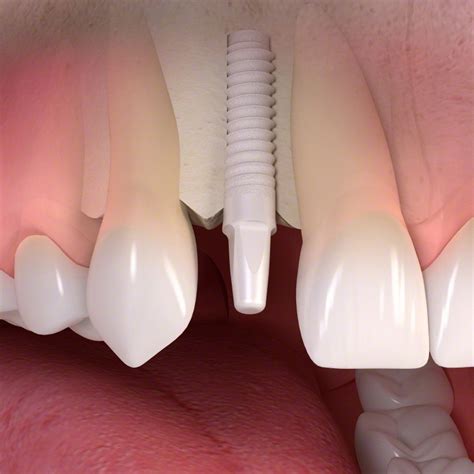 Ceramic Implants | St. Petersburg, Florida | Tampa Bay Dental Implants