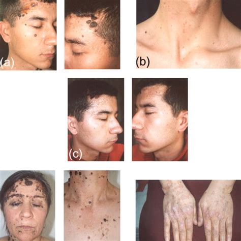 Histology of SK-like viral wart from the boy (a and b) and his mother... | Download Scientific ...