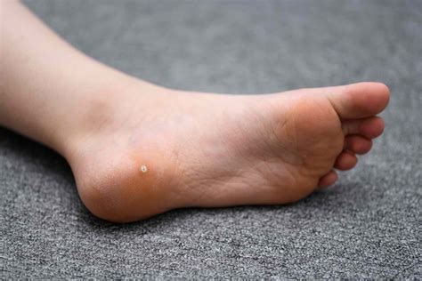 Plantar Warts: Symptoms, Causes, Treatment and More