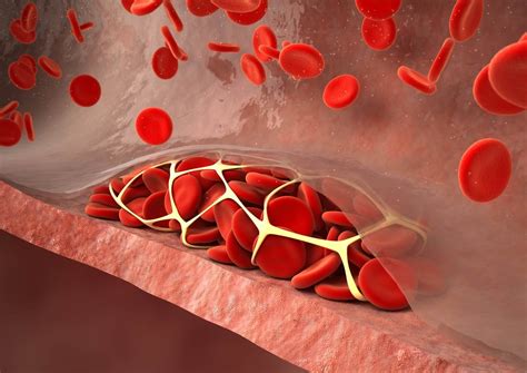 Anticoagulation Therapy With Rivaroxaban Safe, Effective in Children ...