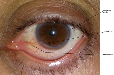 White Ring Around Cornea Of Eye