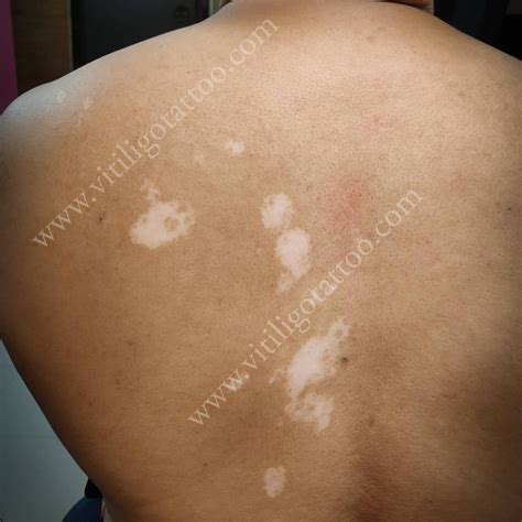 Cost Of Vitiligo Treatment – Vitiligo Tattoo