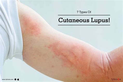 7 Types Of Cutaneous Lupus! - By Dr. Yogesh | Lybrate