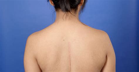 Understanding Scar Scoliosis Surgery: Healing Beyond The Curve