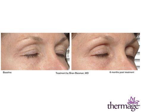 Thermage Eye Procedure | Eyelid Treatment by Brian Biesman, … | Flickr