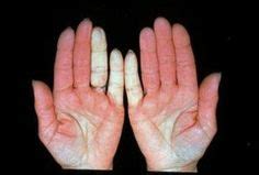 Waldenstrom Macroglobulinemia Symptoms, Causes, Diagnosis, Prevention And Treatment