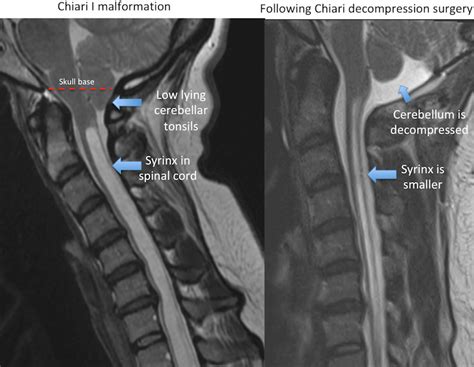 Chiari Malformation - Rocky Mountain Brain and Spine Institute