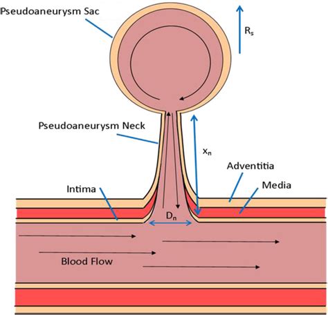 Thrombin‐Loaded Magnetic Microbubbles for the Treatment of Pseudoaneurysms - Thomas - 2022 ...