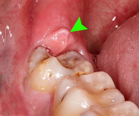 How Do I Know If It's Wisdom Teeth Causing My Jaw Pain?