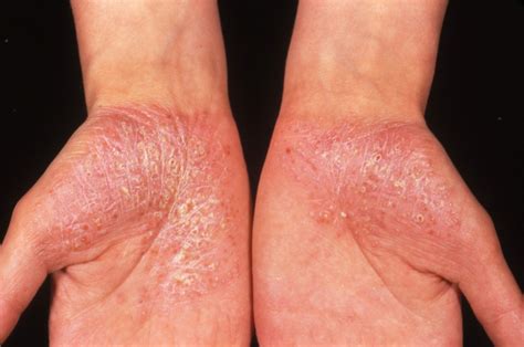 Recognizing and Managing Flares in Generalized Pustular Psoriasis