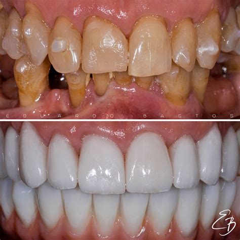 #periodontitis #dentistry #gingivitis #dentist #dentistry # ...