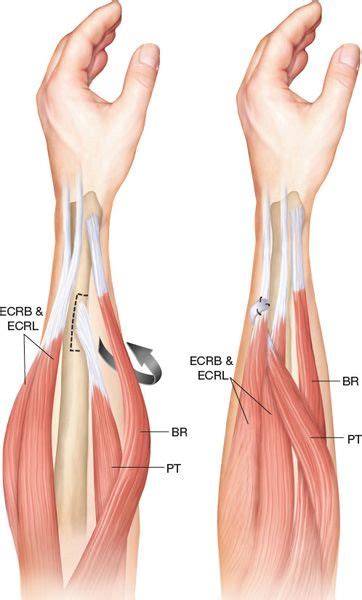 Tendon transfer surgery : Author's experience - Spinal Injury Information network