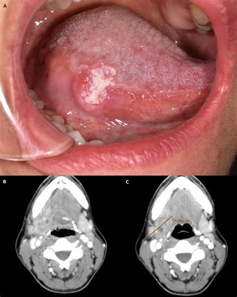 Oral Squamous Cell Carcinoma Floor Of Mouth