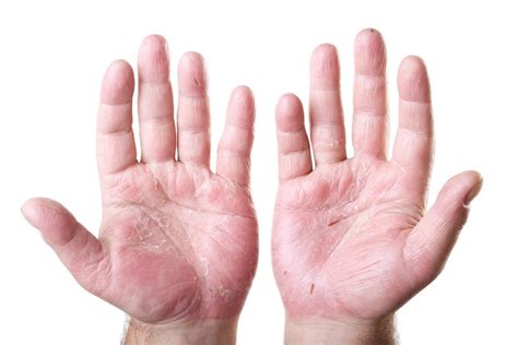 Hand Eczema: Causes, Symptoms and Treatment Options - Reorion Planet