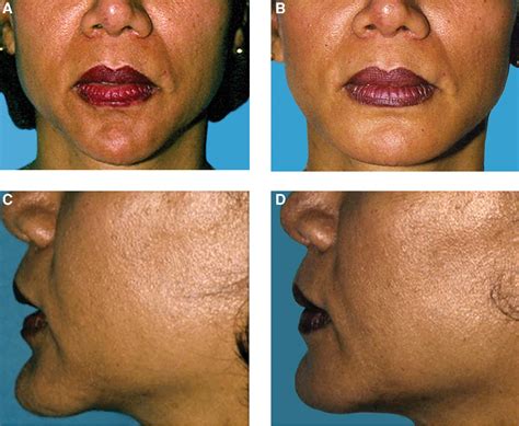 Figure 1 from Management and avoidance of complications in chin ...