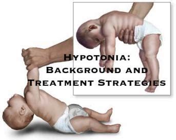 Hypotonia in Children: Physical Therapy Treatment