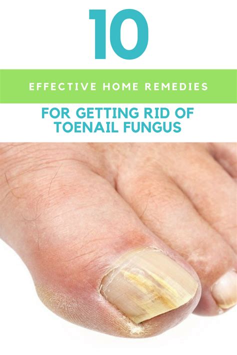 10 Effective Home Remedies For Getting Rid Of Toenail Fungus