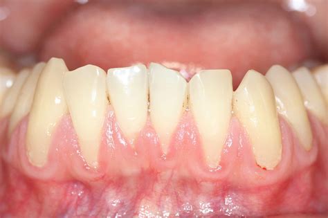 Gum Recession Treatment Surgery | Gum Regeneration Treatment