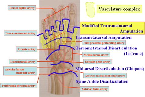 A Modified Transmetatarsal Amputation - The Journal of Foot and Ankle Surgery