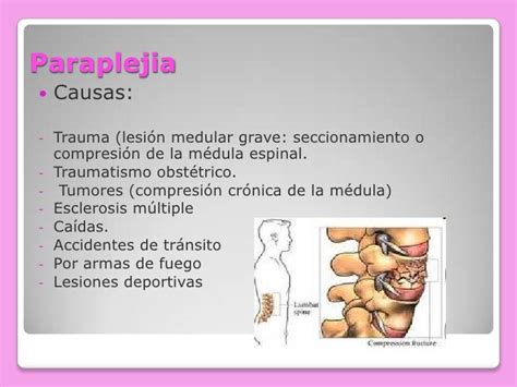 Paraplejía diapositivas