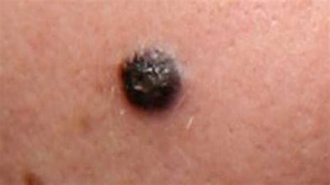 Early Stage Nodular Melanoma