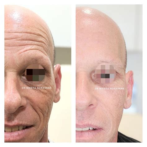 Full Face Botox in 50 yr old Male by Top Dermatologist in Mumbai, Dr Niketa Sonavane - Dr ...