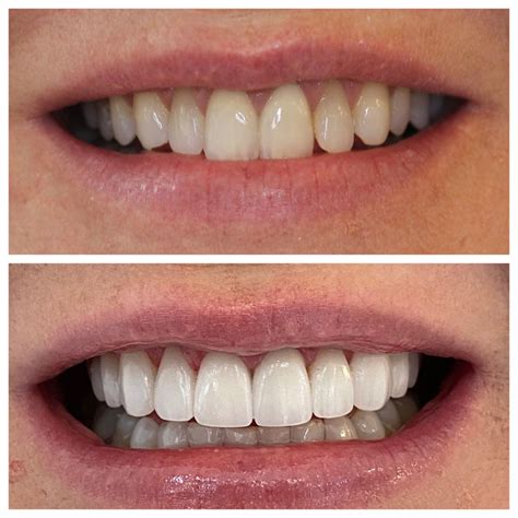 Before & After Gallery | Cosmetic Dentistry Center of NYC