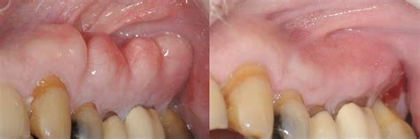 Treatment of Excessive Bony Growths (Exostosis / Tori) in the Jaw Bone | Treatment of Excessive ...