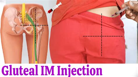 How to give IM (Intramuscular) injection in buttock or hip easily at home | Dorsogluteal ...