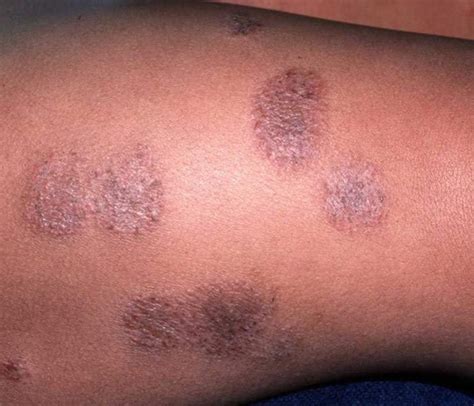 Eczema Skin Rashes That Look Like