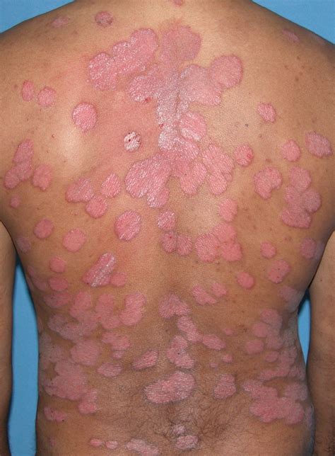 Psoriasis - Pictures