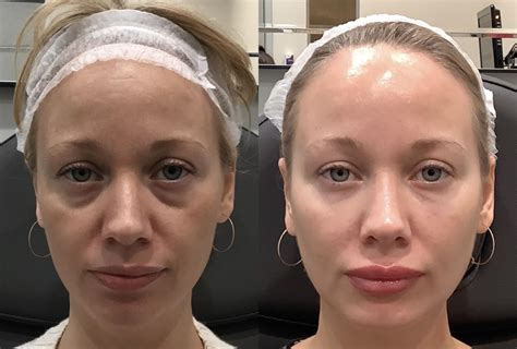 Dermal Fillers Before and After Pictures Case 60 | Sacramento, CA | Destination Aesthetics