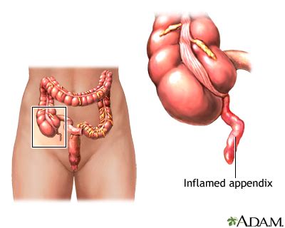 Appendicitis Information | Mount Sinai - New York